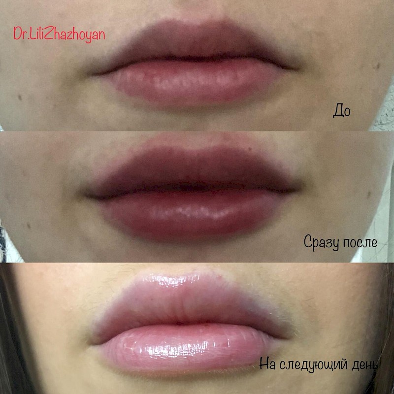Увлажнение губ до и после. Увлажнение губ филлером до и после. Увлажнение губ без увеличения до и после. Увлажнение губ гиалуроновой кислотой без увеличения до после.