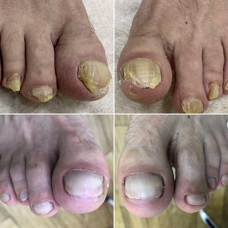 Как лечить грибок на пальцах ног народная медицина